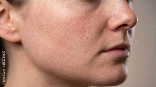 Close up of woman face with skin pores and redness