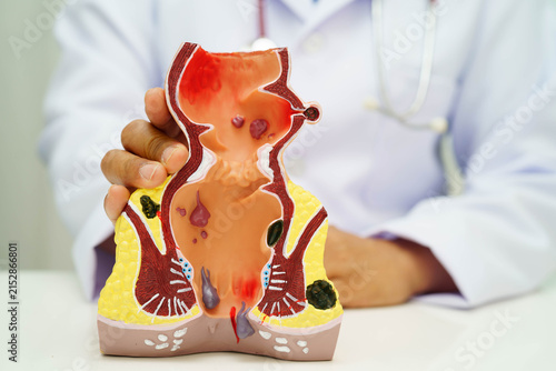 Foto Asian doctor with rectum and hemorrhoid human anatomy model at hospital, inflamed vascular structure