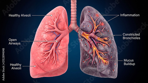 Healthy lung versus diseased lung anatomy showing inflammation constricted bronchioles and mucus buildup for medical education and respiratory health awareness