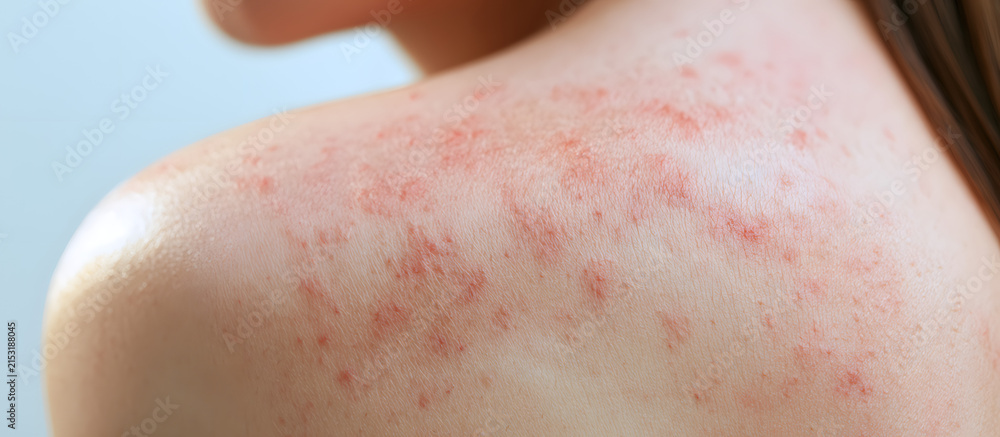 Fototapeta premium A detailed look at the eczema skin rash and atopic dermatitis condition, as seen in a copy space image