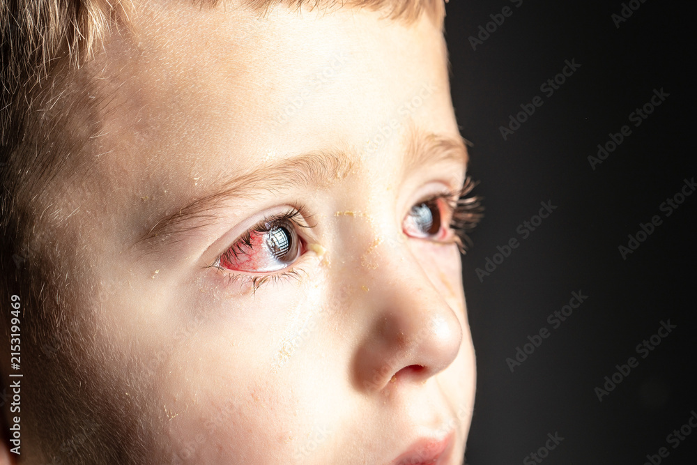 Fototapeta premium Child with Red Eyes and Viral Eye Infection