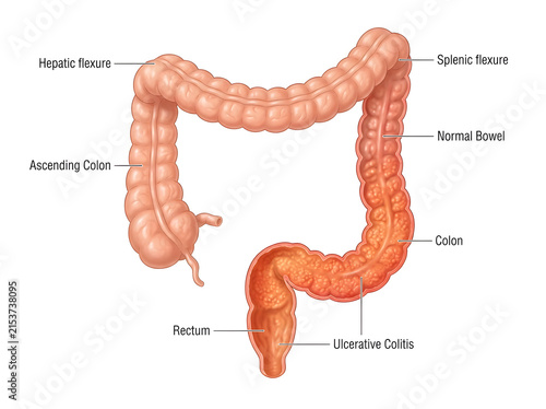 Human digestive system showing ulcerative colitis in colon isolated on white background