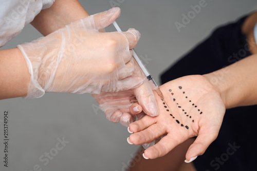 Macro close-up of doctor hands in sterile gloves using syringe with needle on marked female palm. Palmar hyperhidrosis botulinum toxin injection
