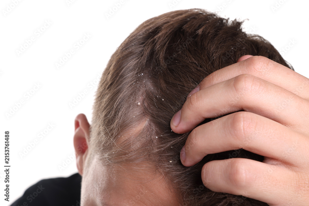 Fototapeta premium Dandruff problem. Man examining his head on white background, closeup