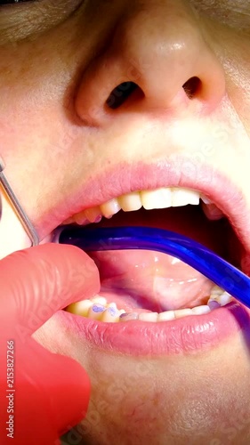 Dental implant crown placement using cheek retractor implant screwdriver and saliva ejector followed by patient smiling at beautiful treatment result in mirror
