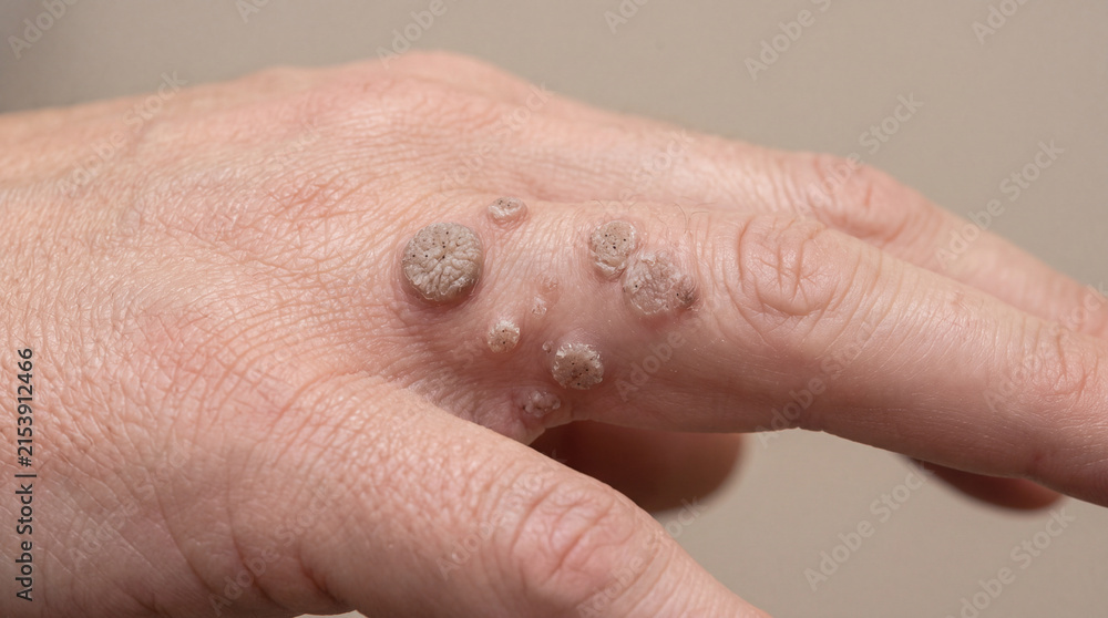 Fototapeta premium Warts on human hand skin close up showing viral skin condition medical dermatology