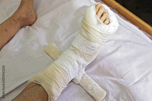 Cuadro en lienzo Plaster Derotational Boot on an Elderly Woman’s Leg