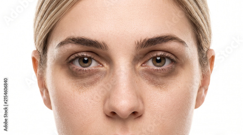 Young fair blonde woman with severe dark circles and tired eyes in extreme close up for skincare dermatology wellness and beauty treatment advertising