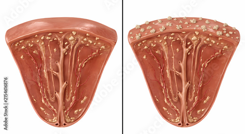 Comparative medical illustration of kidney Randall plaque formation and calcium crystal attachment in renal papilla