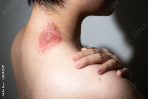 Medical close up of hand touching an itchy allergic irritated skin with a redness  insect bite rash on the neck.  