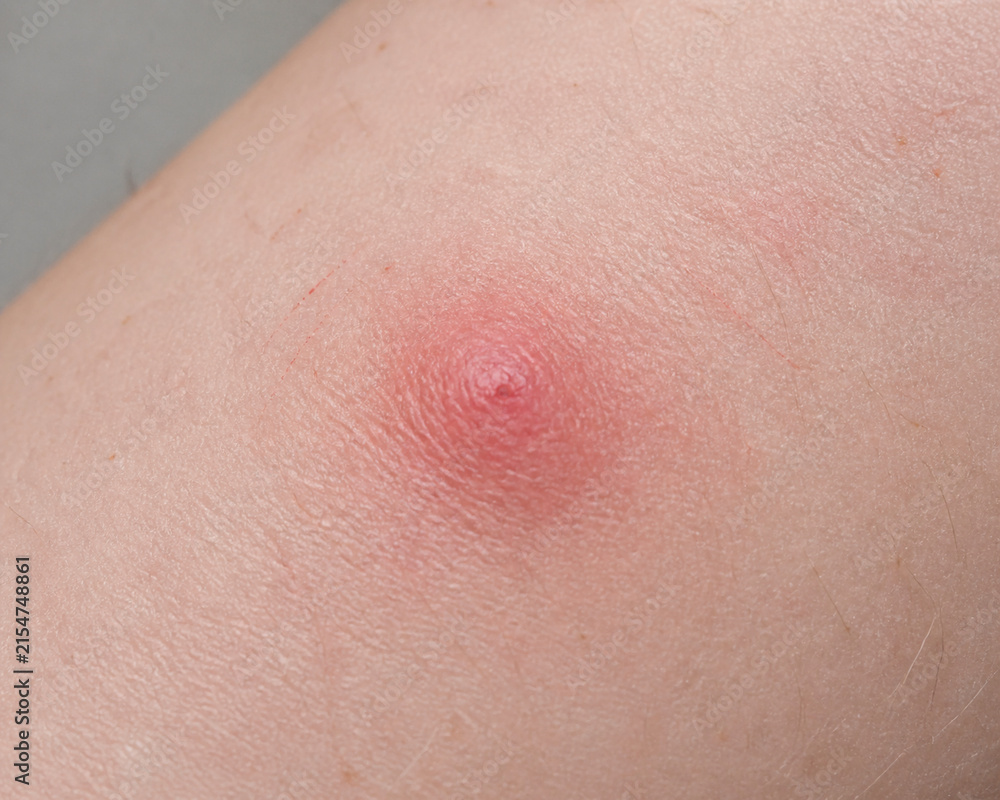Fototapeta premium Red swollen mosquito bite on forearm skin, insect bite irritation and allergy