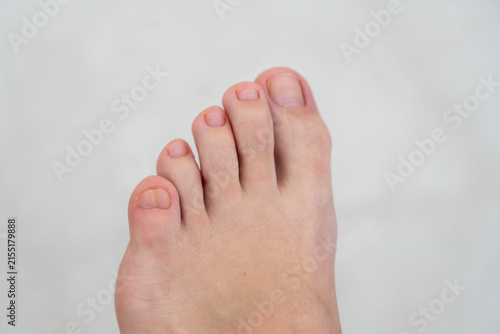 Foto Female feet with big double little toe