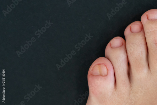 Bild auf Leinwand Female feet with big double little toe on black background