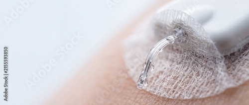 Medical insulin pump infusion set with transparent cannula attached to human skin for continuous glucose monitoring and treatment.