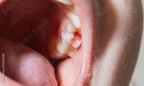Photography Close up view of child mouth revealing damaged tooth showing pulp with red filling material and surrounding inflamed gum tissue detail