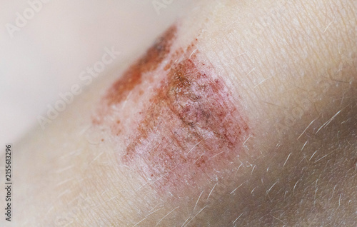 Close-up of acute injury on skin surface of human knee showing red scraped abrasion and minor bleeding, visual representation of injury and pain from fall
