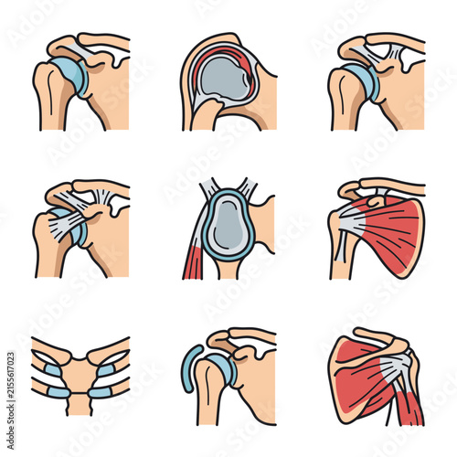Shoulder Joint Anatomy and Injuries Illustrated