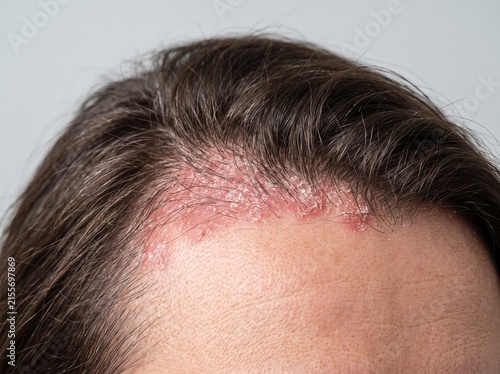 Scalp Psoriasis at Hairline with Plaque and Scaling
