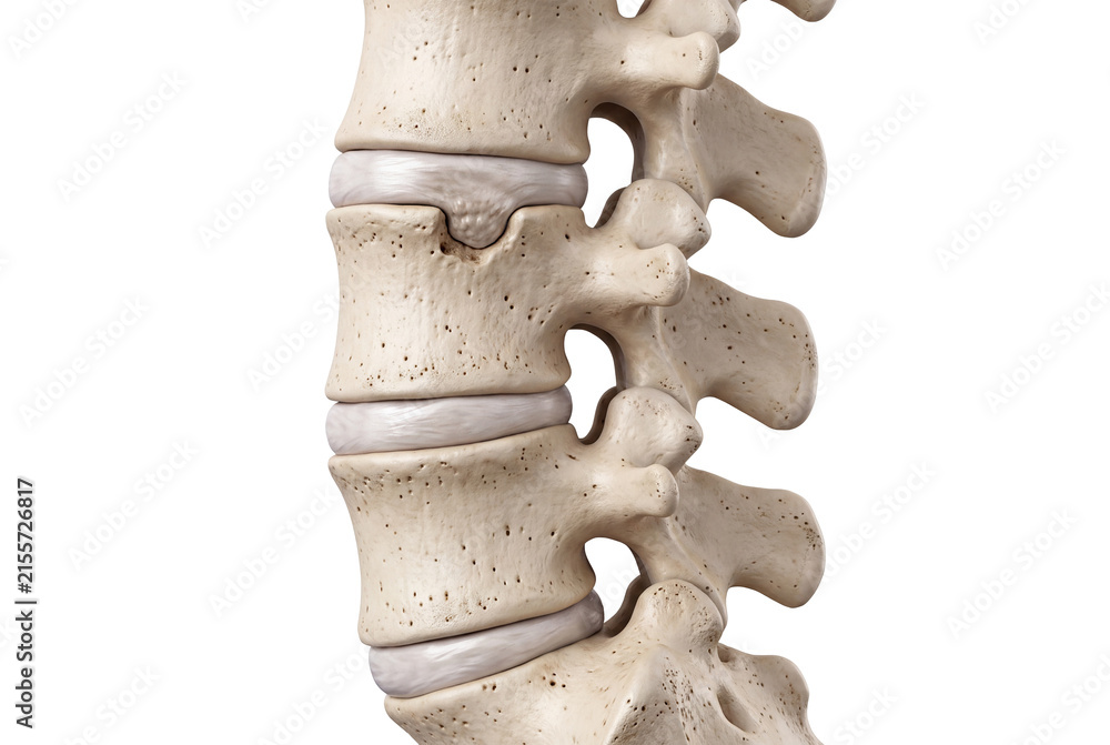 Obraz premium Medical illustration of lumbar vertebrae showing a Schmorl's node, where intervertebral disc material protrudes into the adjacent vertebral body.