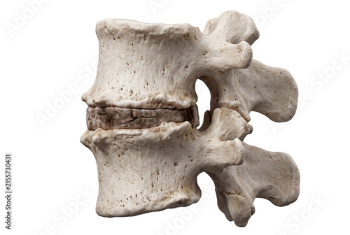 Obraz na płótnie Lumbar vertebrae with severe intervertebral disc height loss from advanced degen