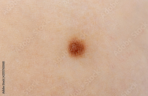 Bild auf Leinwand Skin mole closeup. Macro photo of blemish similar to melanoma