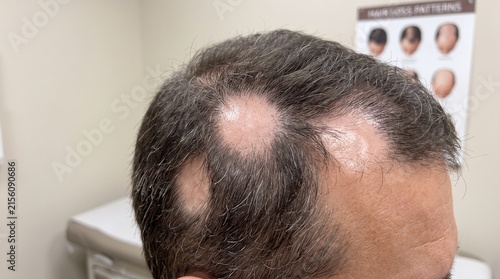 Close up of male scalp with visible hair loss.