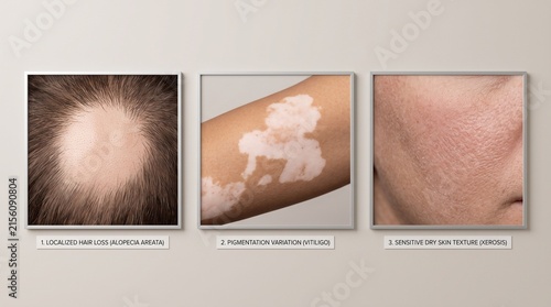 Close up of skin conditions showing vitiligo and eczema.
