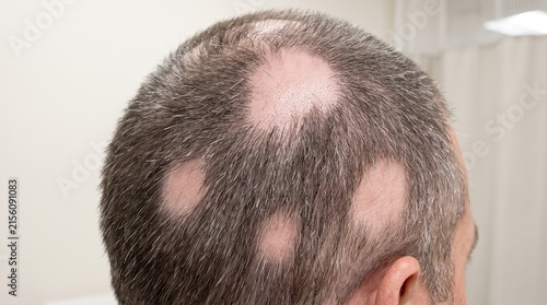 Close up view of male scalp with visible hair loss patches.