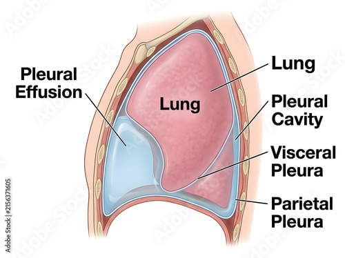 Medical diagram of pleural effusion in lung isolated on white background