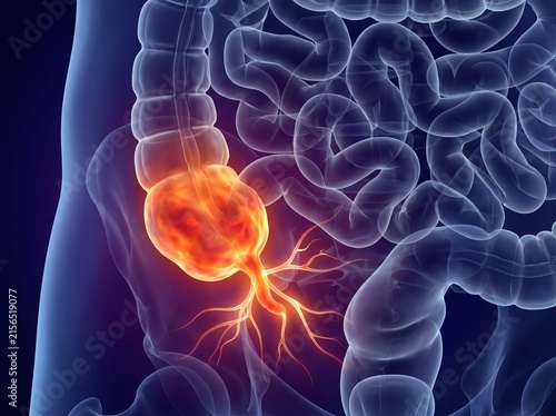 Medical illustration of a cancerous tumor in the human colon.