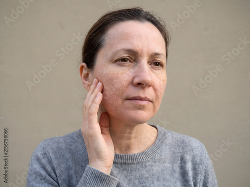 Middle aged woman touching her face with visible dry skin irritation while looking away from the camera in soft lighting