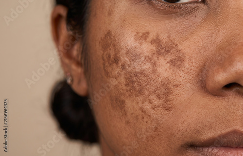 Close Up of Severe Melasma and Hyperpigmentation on Dark Skin Woman Cheek