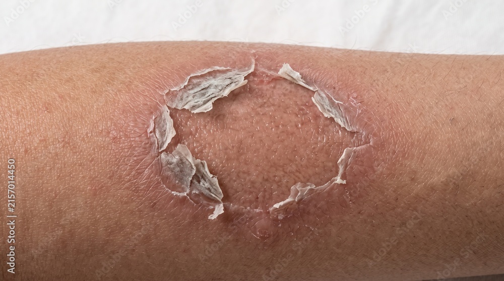 Fototapeta premium Close up of circular peeling skin patch with raw red epidermis, popped blister, sunburn or healing wound recovery