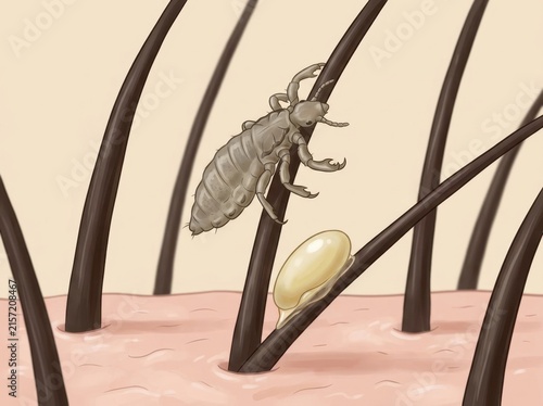 Vector illustration of a head louse and nit egg on hair strands. Life cycle of pediculosis parasite. Educational medical diagram