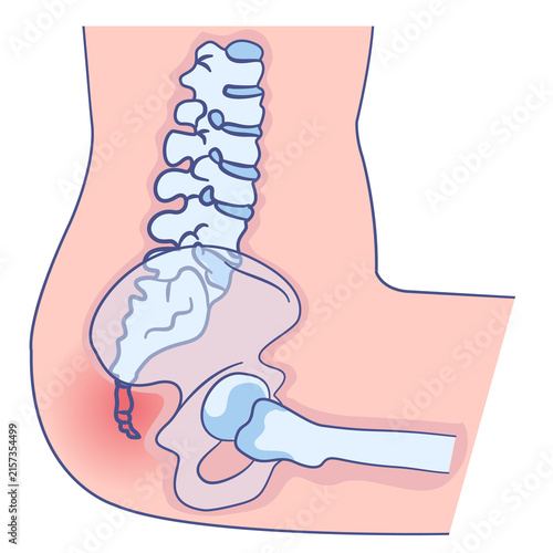Foto Medical illustration of lower back pain highlighting coccyx and spine inflammati