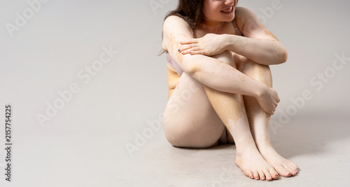 Young woman with vitiligo embracing her skin condition and body positivity