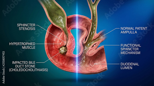 Impacted bile duct stone obstructing sphincter in biliary tract