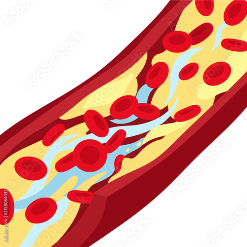 A cross section of a human artery showing blood flow blockage