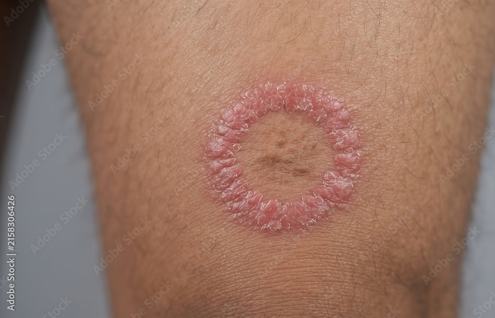 Fototapeta premium Ringworm Tinea Corporis Fungal Infection Red Scaly Rash on Skin