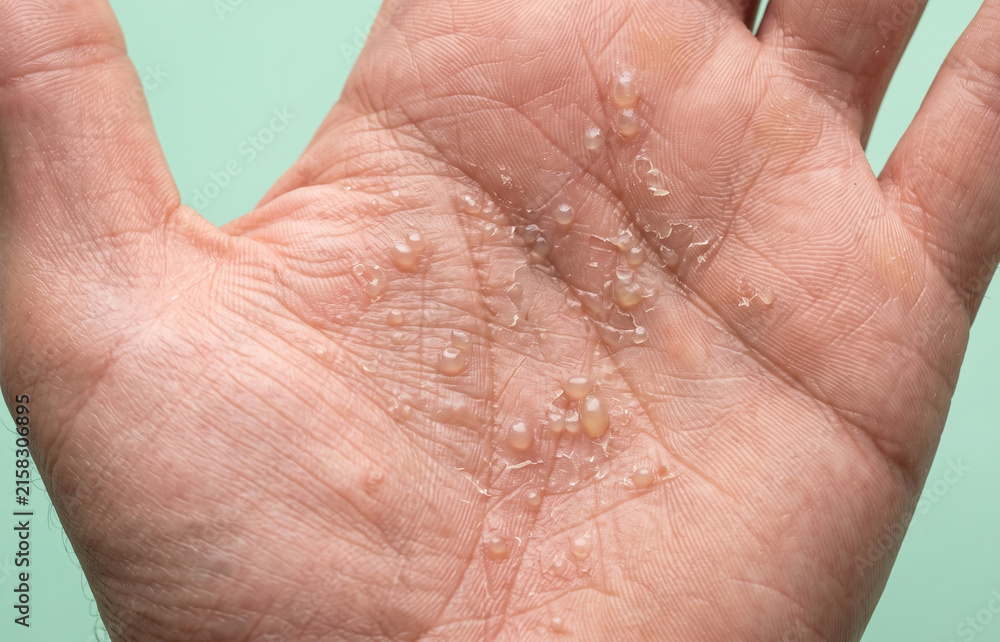 Fototapeta premium Dyshidrotic Eczema Pompholyx Blisters on Human Palm Skin Close Up