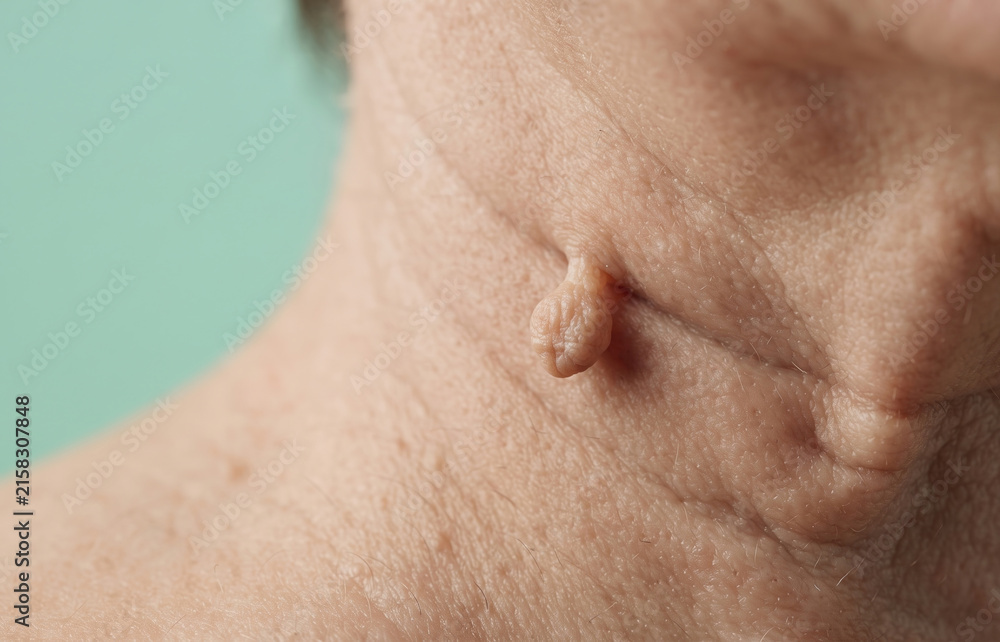 Naklejka premium Macro Close Up of Skin Tag Acrochordon on Mature Woman Neck