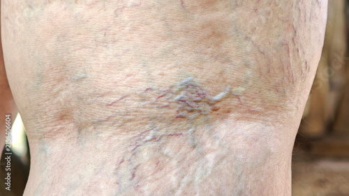 Close-up photograph of the woman's legs shows varicose veins and broken capillaries on the skin of her legs, indicating that she has a health problem.