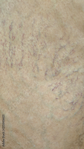 Close-up photograph of the woman's legs shows varicose veins and broken capillaries on the skin of her legs, indicating that she has a health problem.