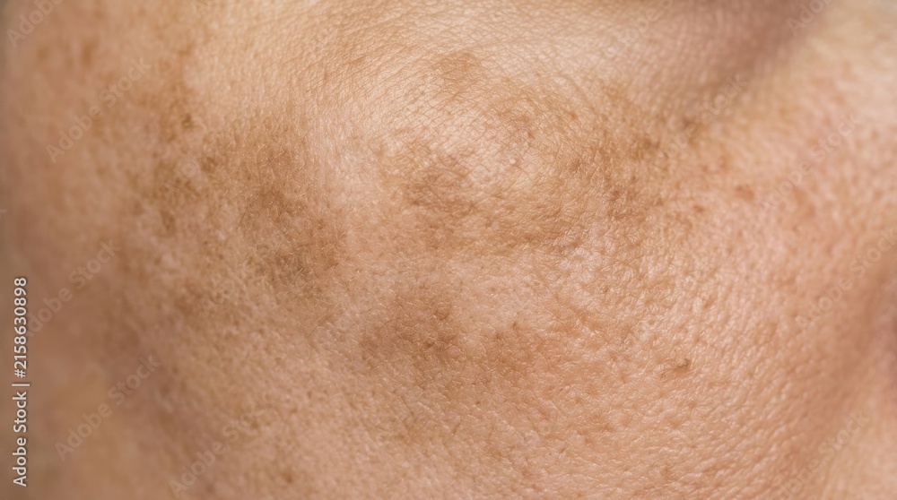 Fototapeta premium Close up view of human skin texture showing freckles and natural pigmentation on a person face