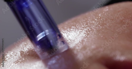Slow motion close up of microneedling pen pressing into facial skin in clinical setting macro tracking shot.