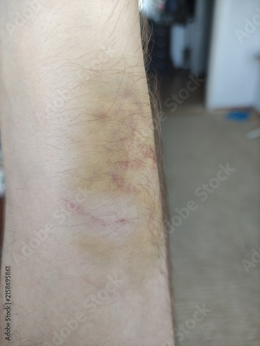 Foto Healing bruise with yellow and red discoloration on hairy human arm close up
