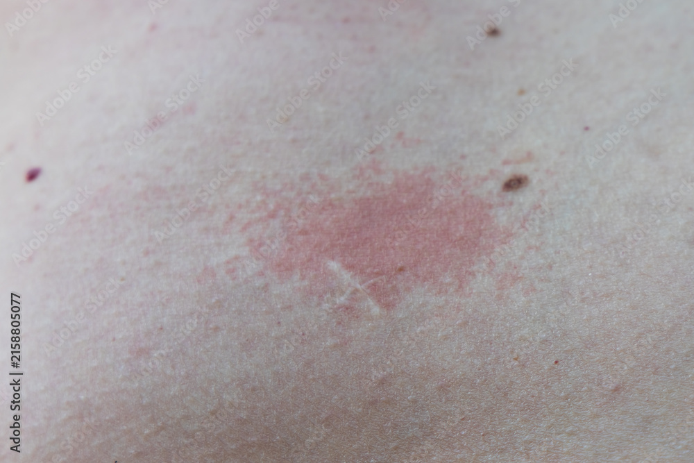Fototapeta premium Close-up of red skin rash or allergy on abdomen, dermatitis, skin irritation, healthcare.