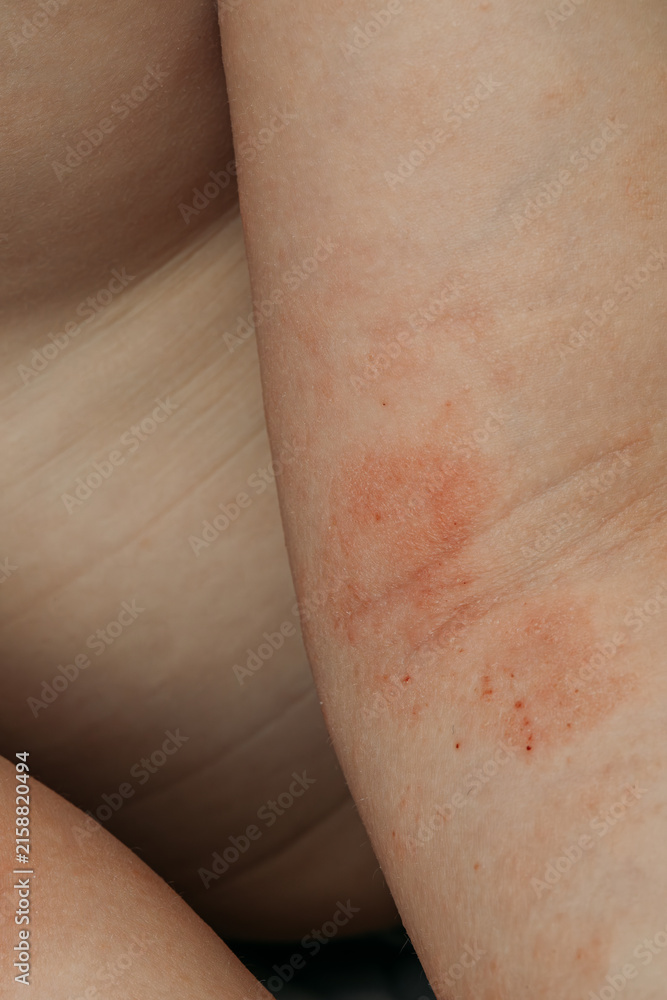 Fototapeta premium Close-up of a child's arm with red, irritated skin from dermatitis.