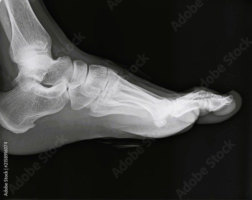 Canvas Print Lateral and AP view X-ray scan of human foot and ankle showing tarsal bones and