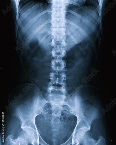 Fotografía Frontal AP view X-ray scan of human lumbar spine sacrum and pelvic bones